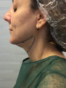 liposuzione-del-collo-pre-intervento